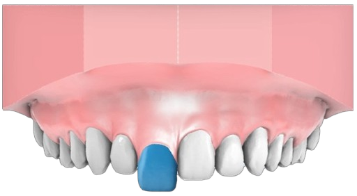 3mm