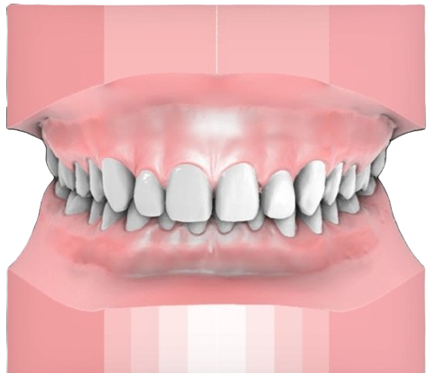 Deep Bite