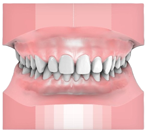 Up to 2mm