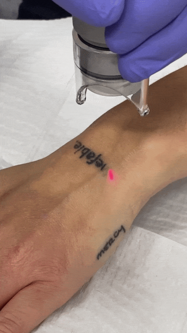 Tattoo Removal At Perfect B