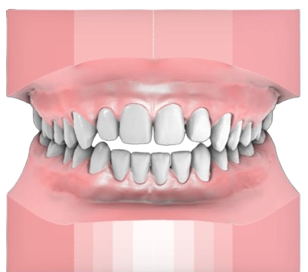 Open Bite