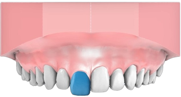 2mm