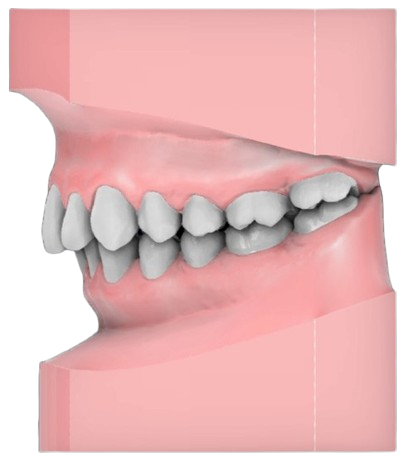 Class II